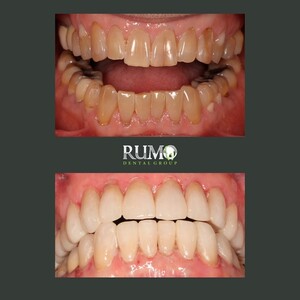 Image of Teeth whitening