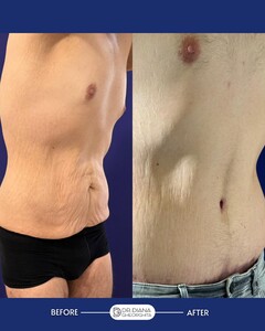 Image of Abdominoplasty, Dr. Diana Gheorghita