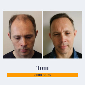 Image of Hair transplant 