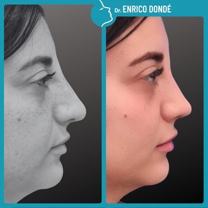 Image of Rhinoplasty