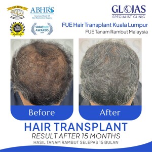 Image of Hair Loss Treatment