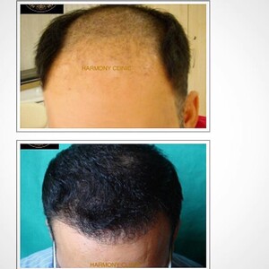 Image of Hair transplant