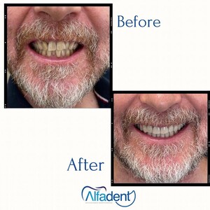 Image of Invisalign and teeth whitening