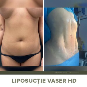 Image of VASER Lipo - Dr Adrian Racu