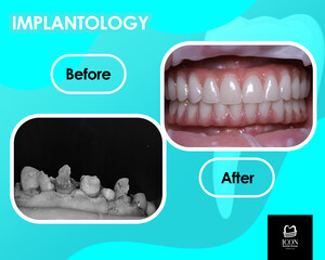 Image of Dental implants