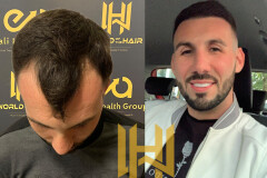 Image of MD.Adem Köse - Hair Transplant Turkey Gallery 3