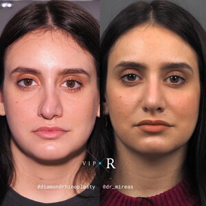 Image of VIP-Rhinoplasty Center - Dr. Moireas Georgios Gallery 0