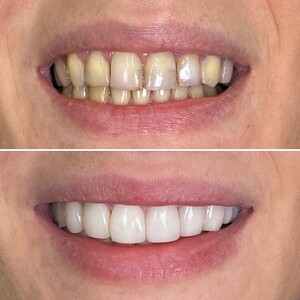 Image of Veneers - Dr. Teodora Dumitriu