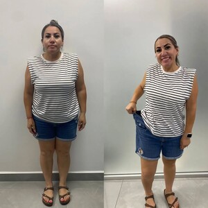 Image of Weight loss surgery in Mexico