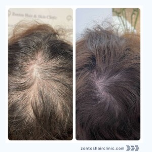 Image of Hair loss treatment