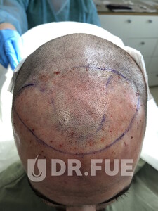 Image of Fue hair transplant - Dr. FUE