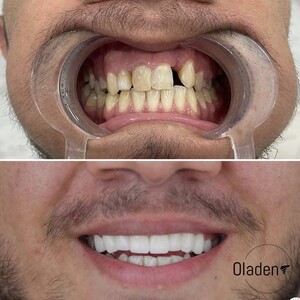 Image of Dental crowns