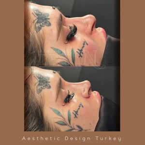 Image of Nose job - Aesthetic Design Turkey