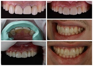 Image of teeth Cleaning - Amadenta