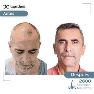 Image of Hair transplant results