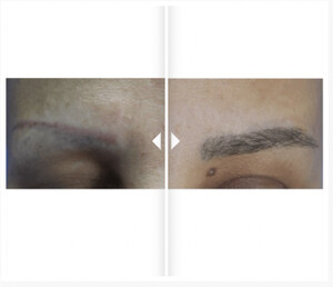 Image of Eyebrow Transplantation Before and After