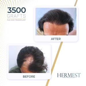 Image of Hermest Hair Transplant Gallery 1