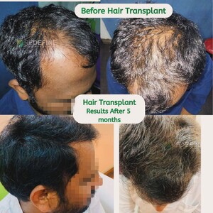 Image of Hair transplant results