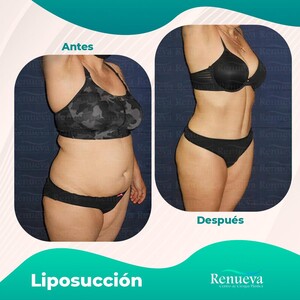 Image of Liposuction