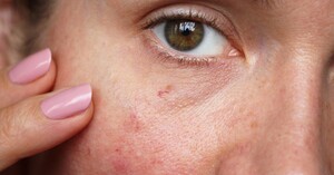 Image of Rosacea - Dermatology Clinic