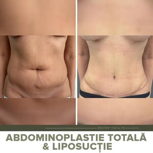 Image of Abdominoplasty - Dr Adrian Racu