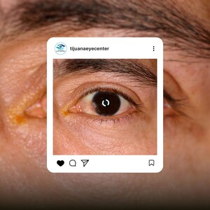 Image of Pterygium Surgery