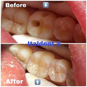 Image of Dental Fillings - Italdent