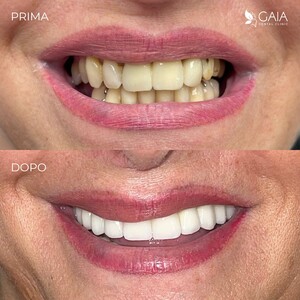 Image of Teeth whitening