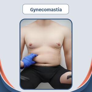 Image of Cauris Health - Gynecomastia