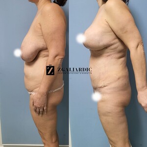 Image of Breast reduction - tummy tuck - Dr. Zgaljardic Clinic