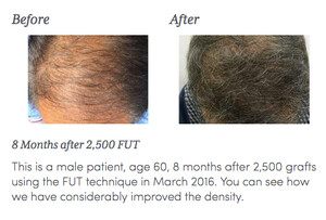 Image of 8 months after FUT hair transplant 