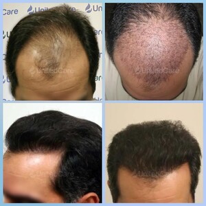 Image of UnitedCare Hair Transplant Clinic Turkey Gallery 0