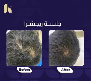 Image of Hair loss - Al Hokail Medical Center