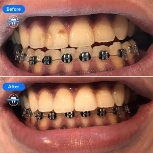 Image of Before and After Dental Care