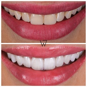 Image of Teeth whitening