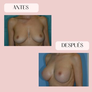 Image of Breast Augmentation - Millan Mateo Institute