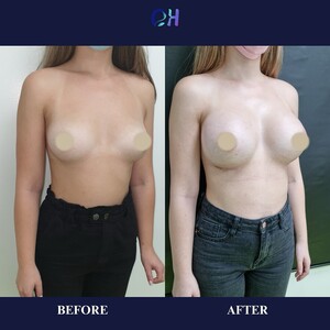 Image of Breast augmentation - Dr. Olimpiu Harceaga