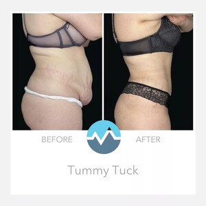 Image of Tummy Tuck