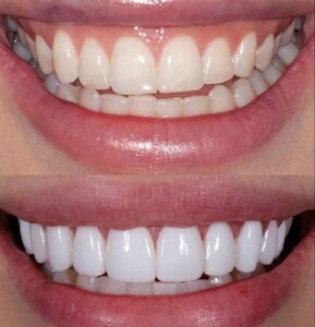 Image of Hollywood smile - Dr. Wael Fekry