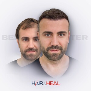 Image of Hair transplantation 