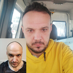 Image of Get DHI Hair Transplant Antalya Gallery 0