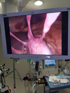 Image of Gastric sleeve - Intraobes