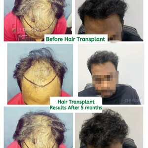 Image of Hair transplant results after 5 months