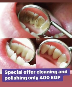 Image of Dental cleaning - Dr. Wael Fekry