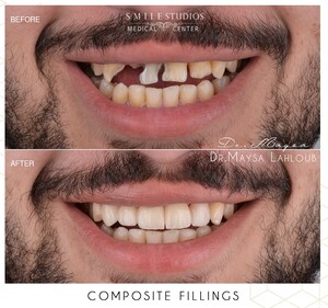 Image of Composite fillings