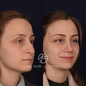 Image of Aesthetic nose surgery - Dr. Kadir Yücebaş