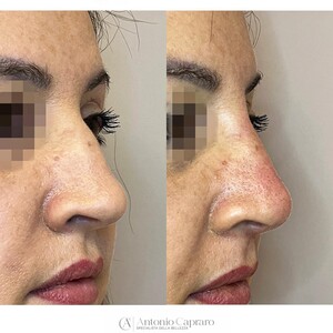 Image of Rhinoplasty