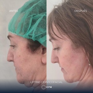 Image of Face lift