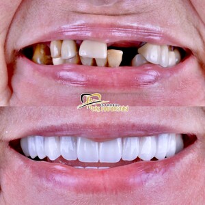 Image of Dental implants - Istanbul Diş Akademisi