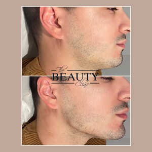 Image of Jawline Contour -  The Beauty Clinic